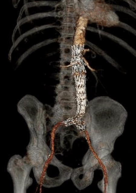 Fenestrated aortic endovascular repair