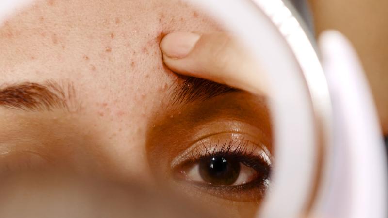 A person looking in a mirror at facial acne.