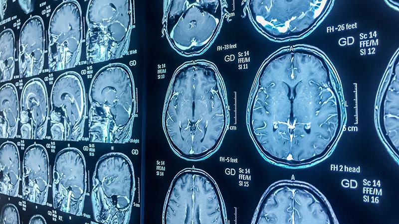 brain scans on a light board